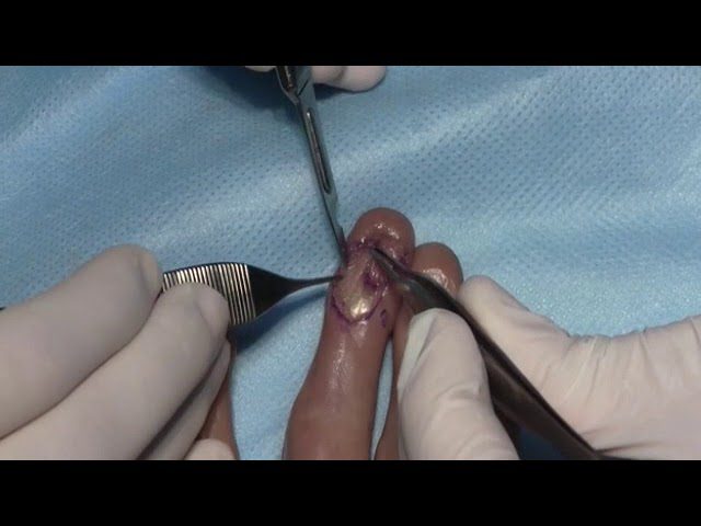 Colgajo de Atasoy: Todo lo que necesitas saber sobre esta técnica quirúrgica innovadora