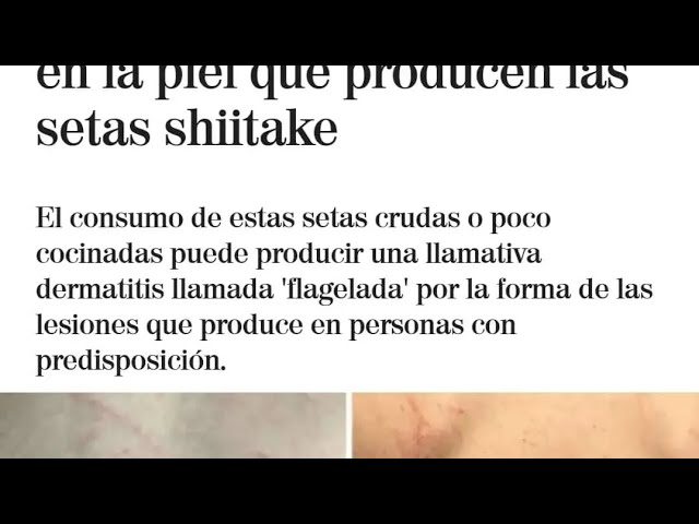 Dermatitis flagelada por shiitake: Causas, síntomas y tratamiento de esta enfermedad cutánea