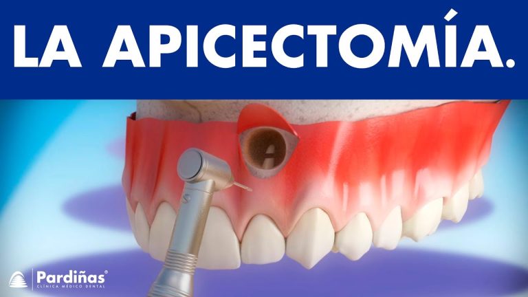 Descubre los mejores instrumentales para apicectomía: herramientas indispensables para un procedimiento exitoso