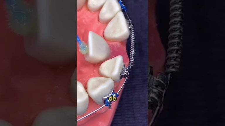 Ortodoncia: La solución perfecta para corregir un único diente de manera efectiva