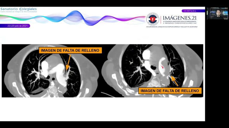 Todo lo que debes saber sobre el sarcoma intimal de arteria pulmonar: causas, síntomas y tratamiento