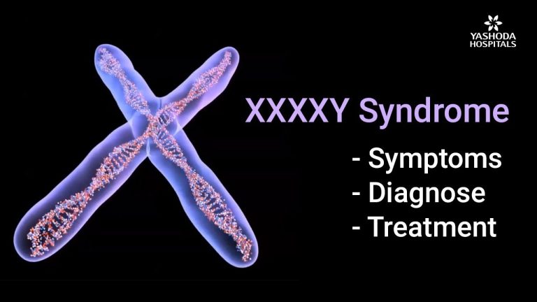 Todo lo que necesitas saber sobre el síndrome 49 XXXXY: causas, síntomas y tratamiento