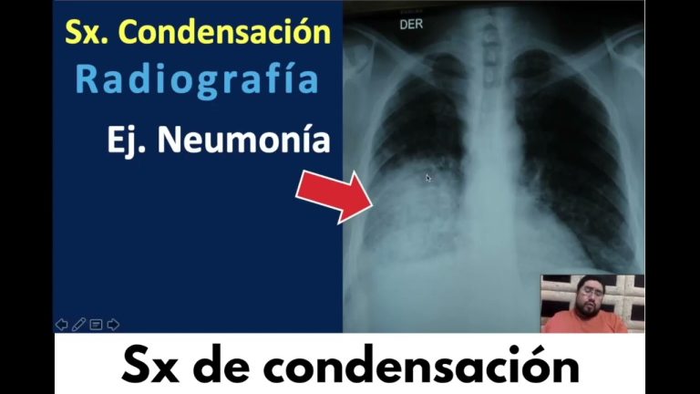 Descarga gratuita del completo PDF sobre el síndrome de condensación pulmonar: todo lo que debes saber